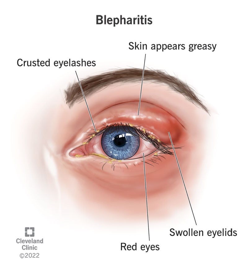 睑缘炎的症状包括眼睑皮肤油腻、肿胀、睫毛结痂和眼白发红。